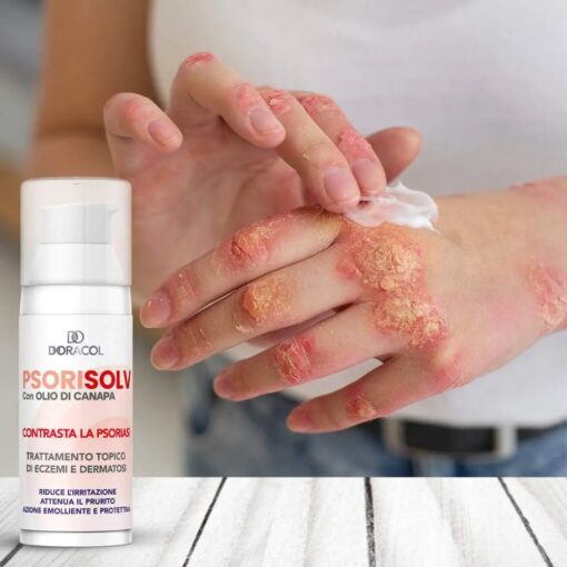 Sorisolv - Psoriasis Cream - Image 2