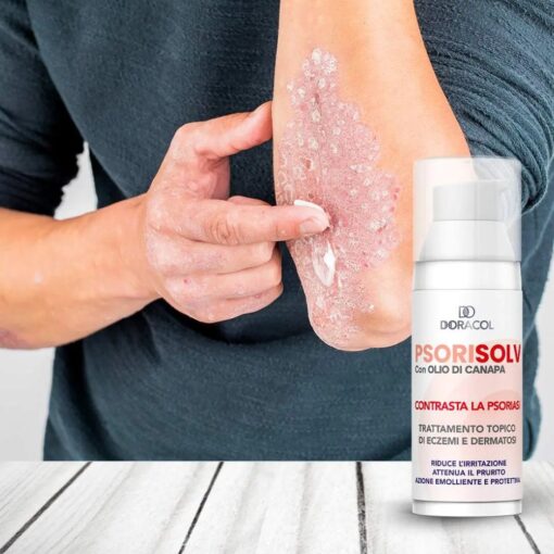 Sorisolv - Psoriasis Cream - Image 3