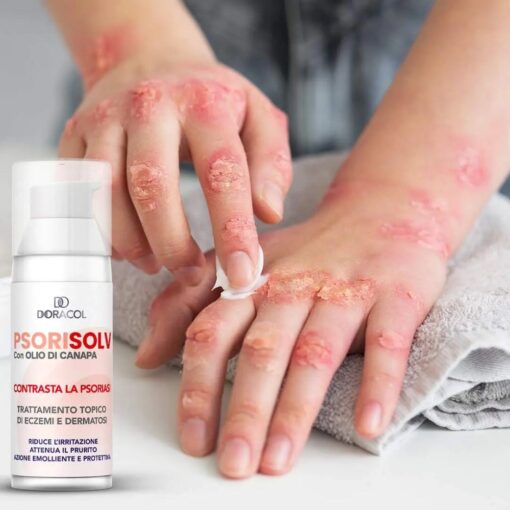 Sorisolv - Psoriasis Cream